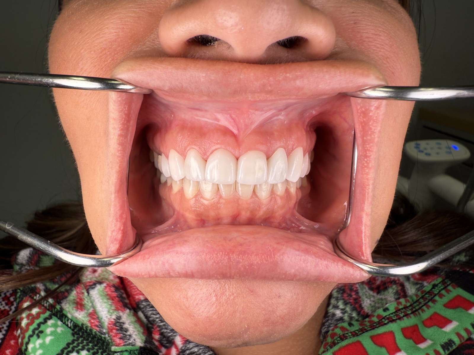 Close-up of the same patient’s minimal-prep veneers